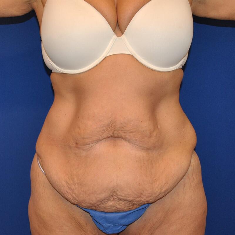 Tummy Tuck Before & After Image