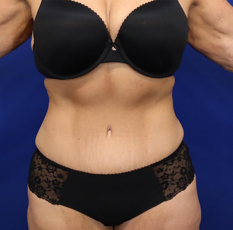 Tummy Tuck Before & After Image