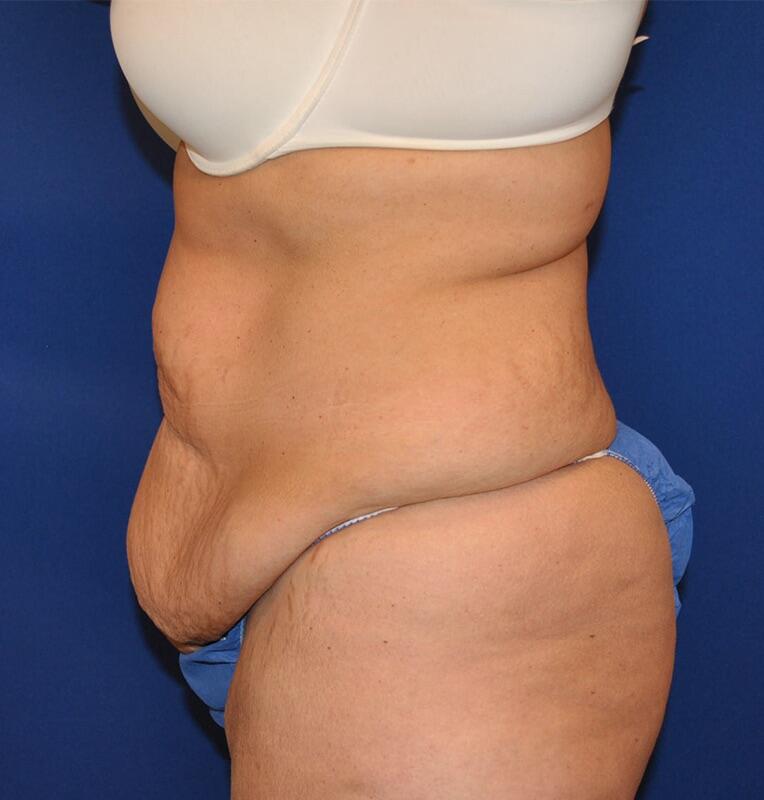 Tummy Tuck Before & After Image