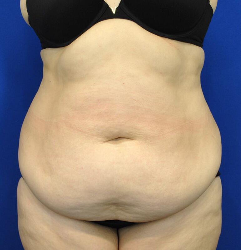 Tummy Tuck Before & After Image