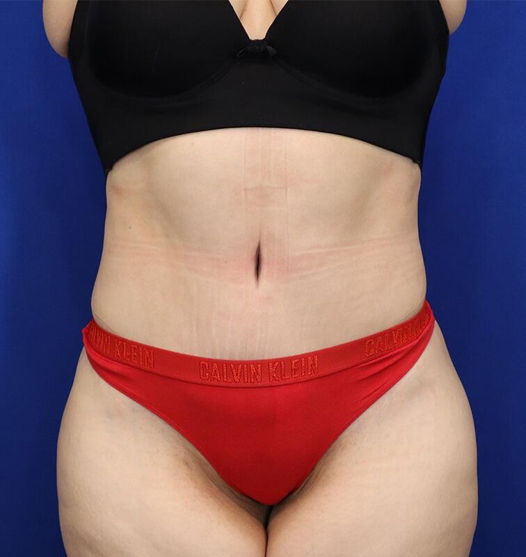 Tummy Tuck Before & After Image