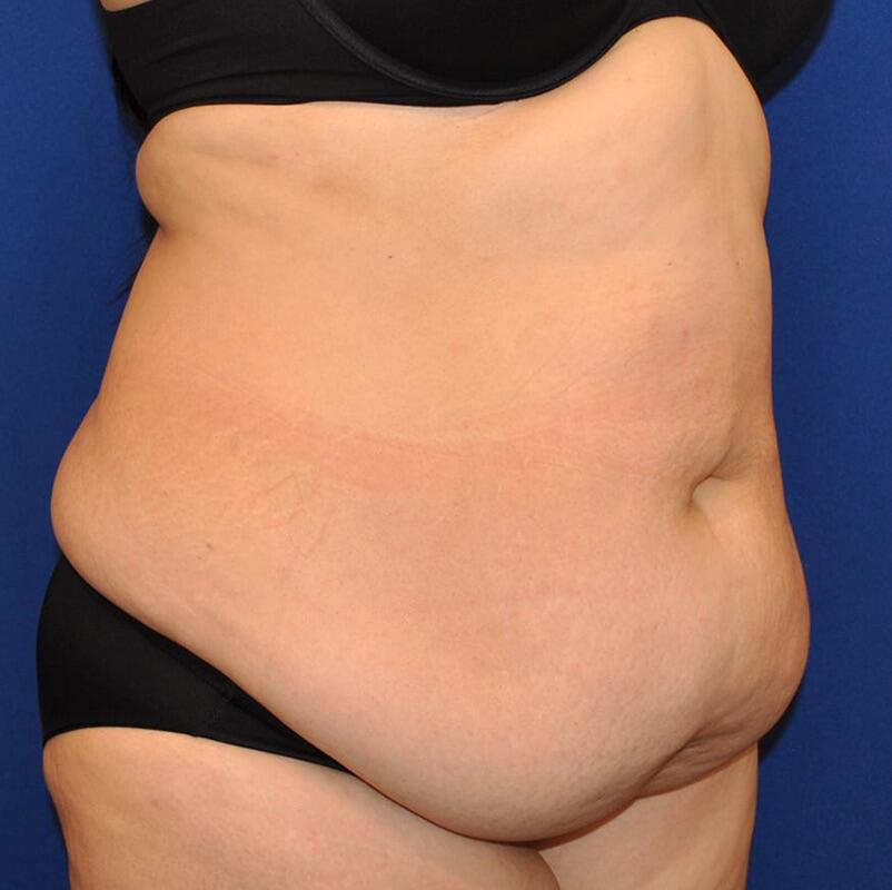 Tummy Tuck Before & After Image