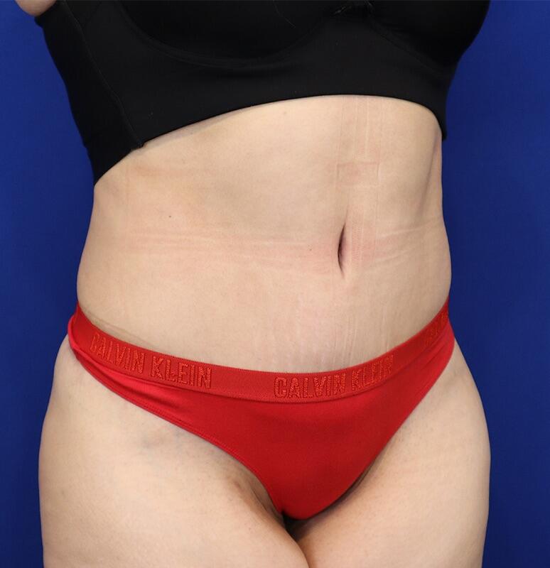 Tummy Tuck Before & After Image