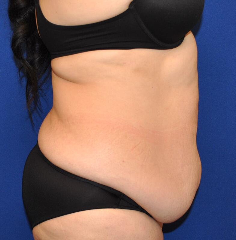 Tummy Tuck Before & After Image