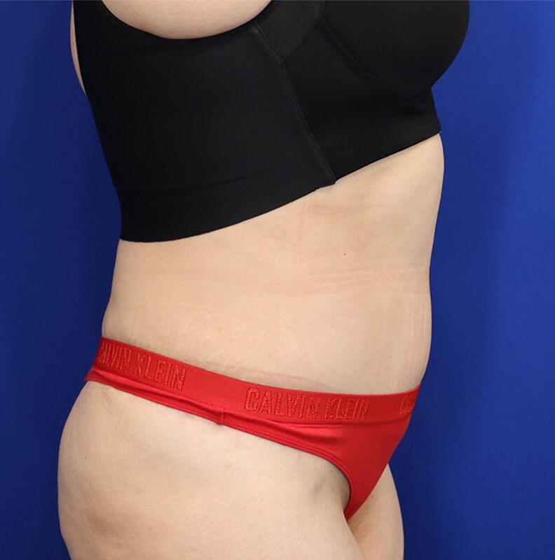 Tummy Tuck Before & After Image