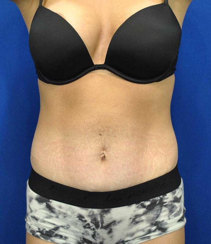 Tummy Tuck Before & After Image