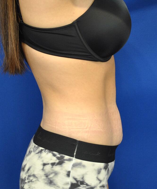 Tummy Tuck Before & After Image