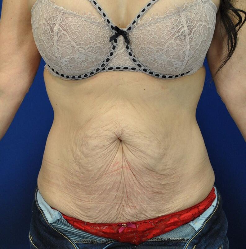 Tummy Tuck Before & After Image