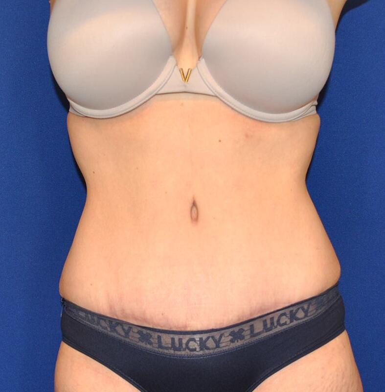 Tummy Tuck Before & After Image