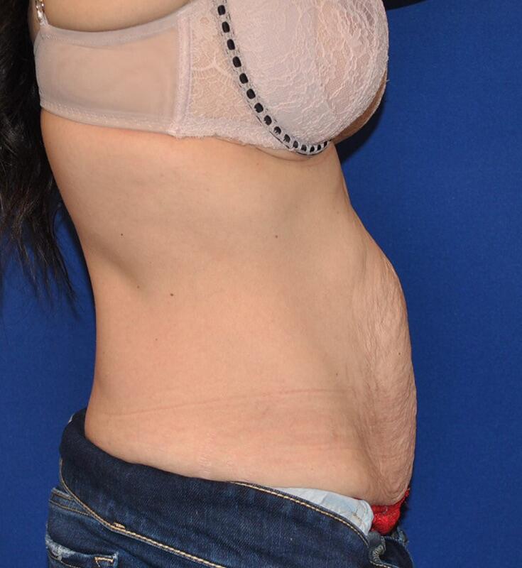 Tummy Tuck Before & After Image