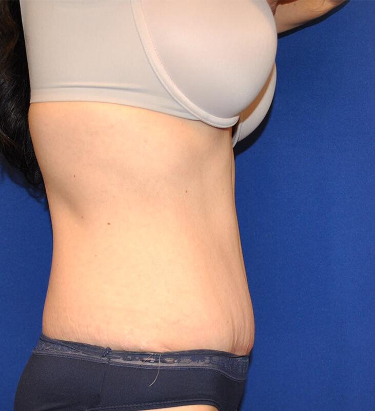 Tummy Tuck Before & After Image