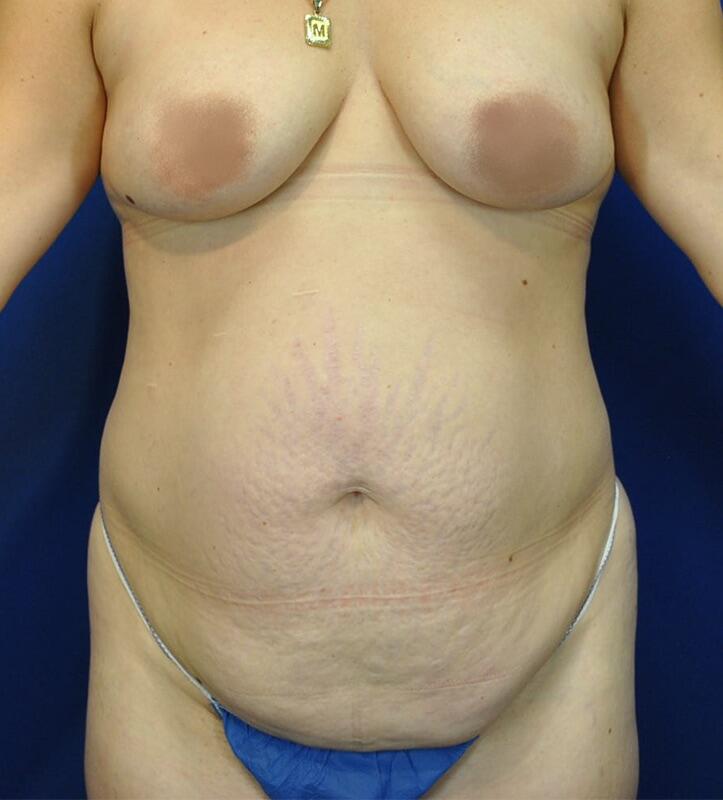 Tummy Tuck Before & After Image