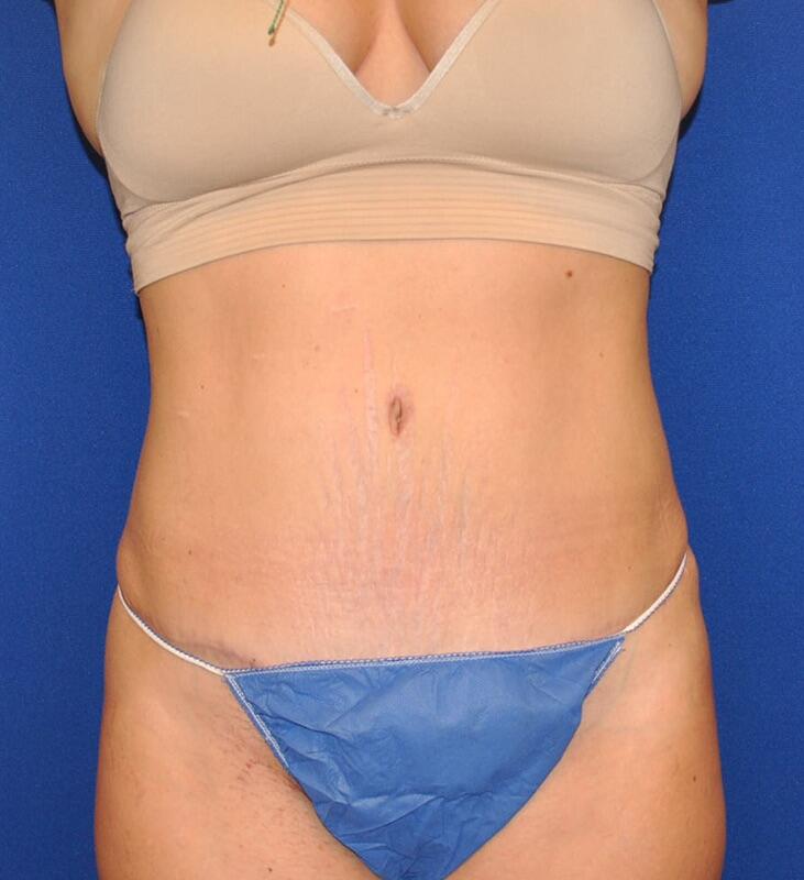 Tummy Tuck Before & After Image