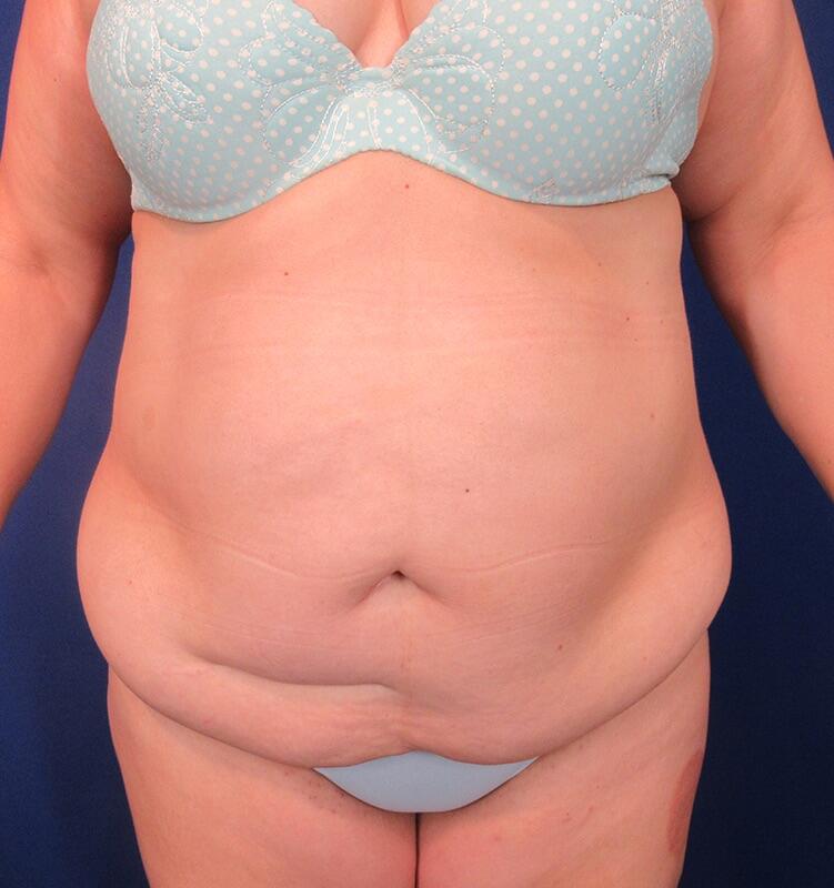 Tummy Tuck Before & After Image