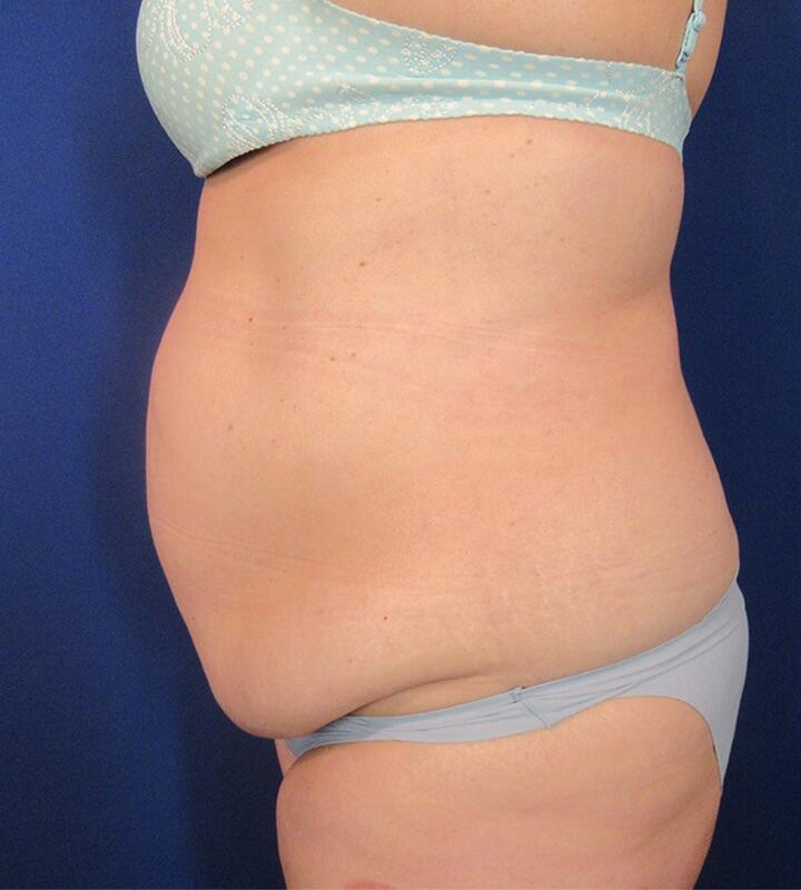 Tummy Tuck Before & After Image