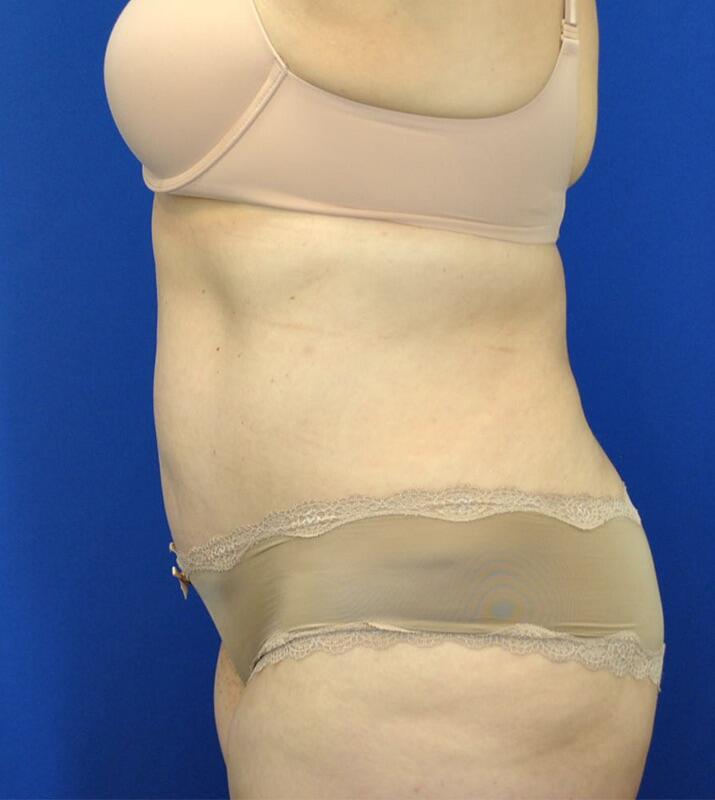 Tummy Tuck Before & After Image