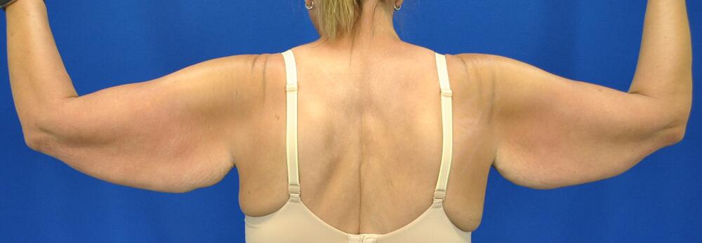 Brachioplasty Before & After Image