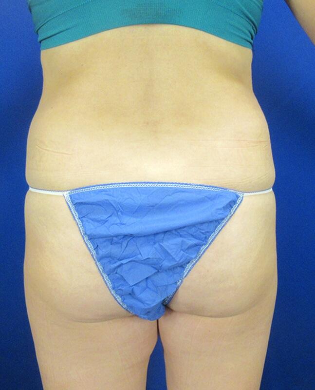 Brazilian Butt lift Before & After Image