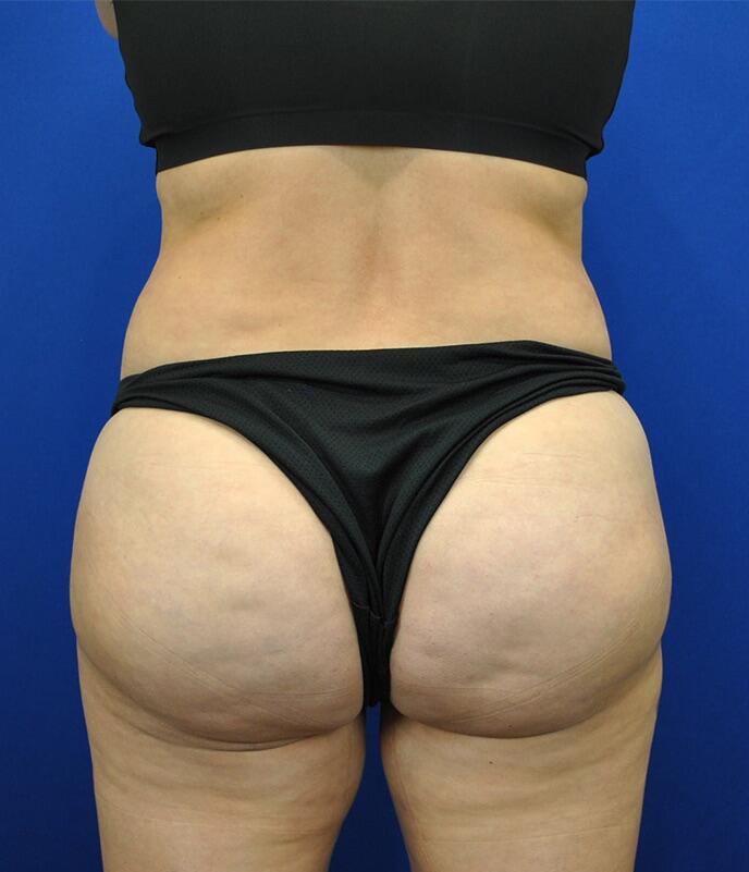 Brazilian Butt lift Before & After Image