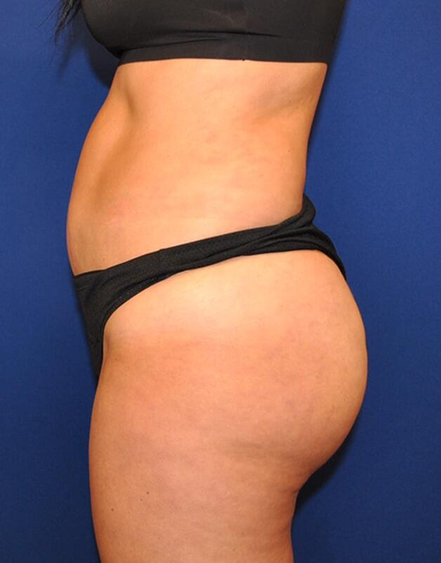 Brazilian Butt lift Before & After Image