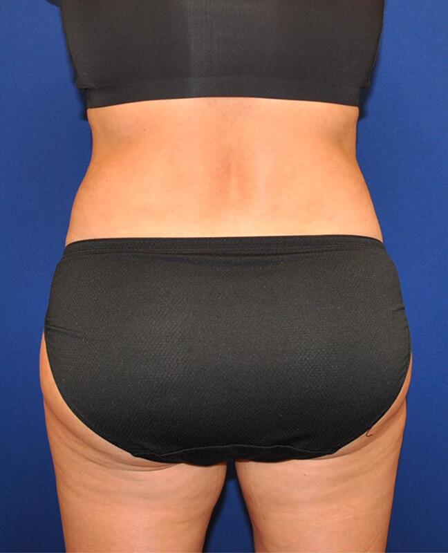 Brazilian Butt lift Before & After Image