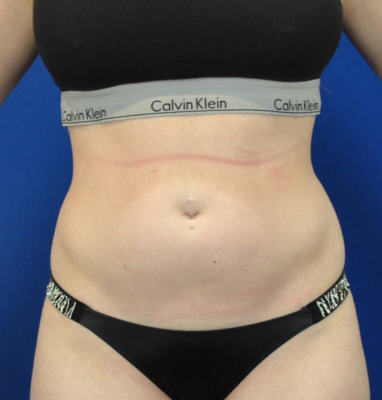 Liposuction Before & After Image