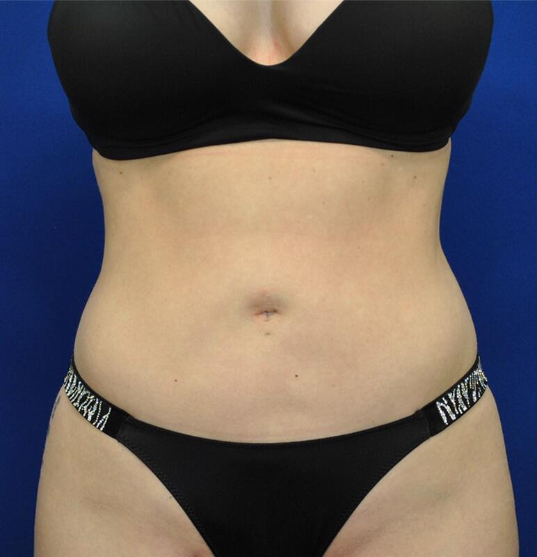 Liposuction Before & After Image