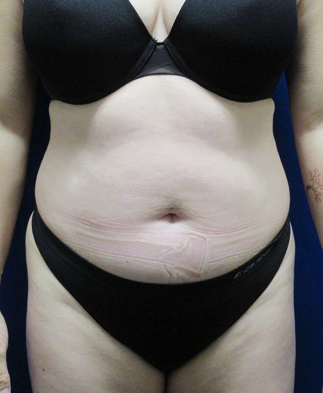 Liposuction Before & After Image