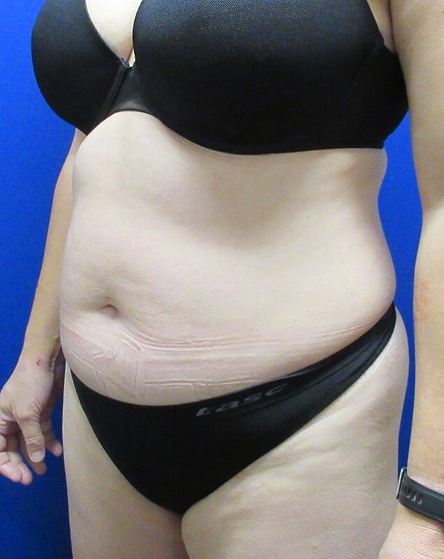 Liposuction Before & After Image