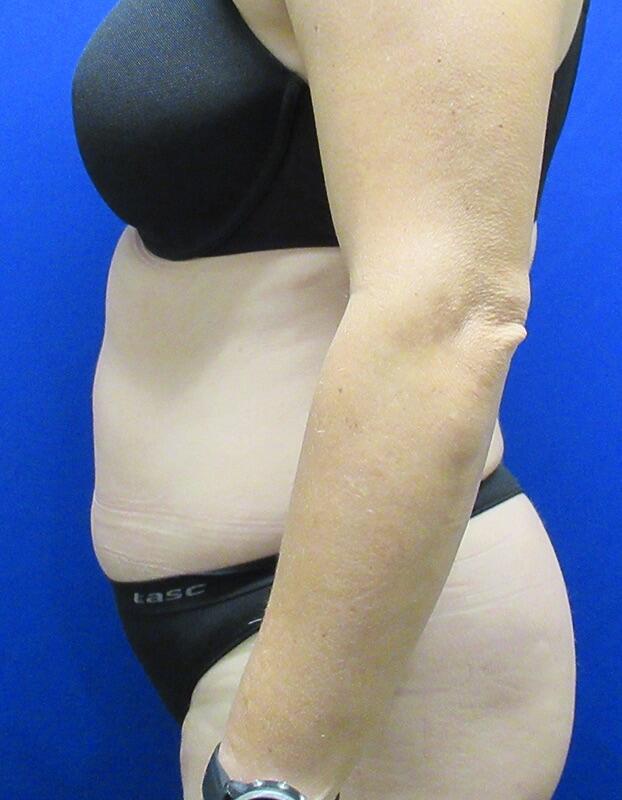 Liposuction Before & After Image