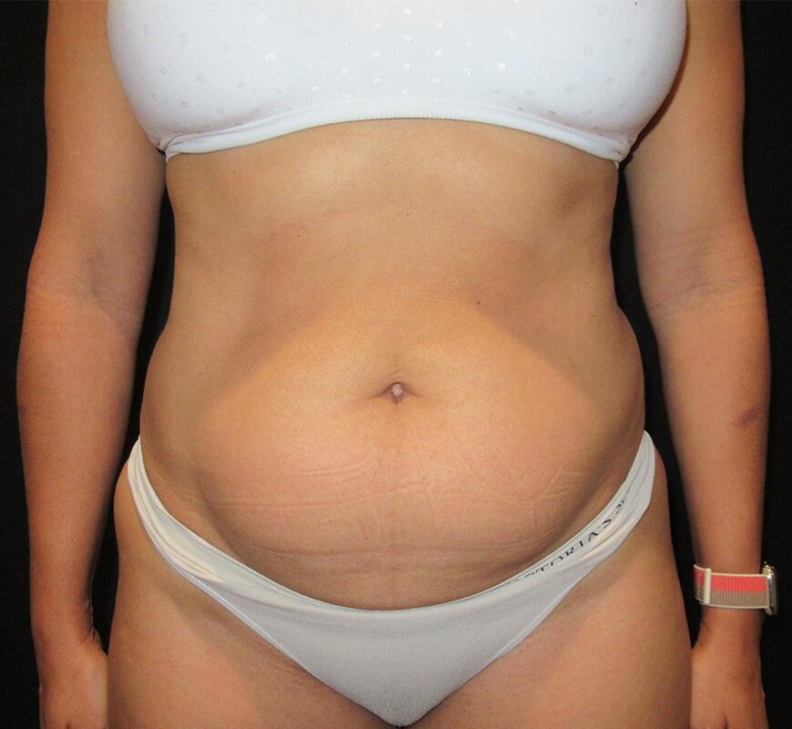 Liposuction Before & After Image