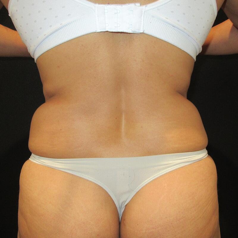 Liposuction Before & After Image