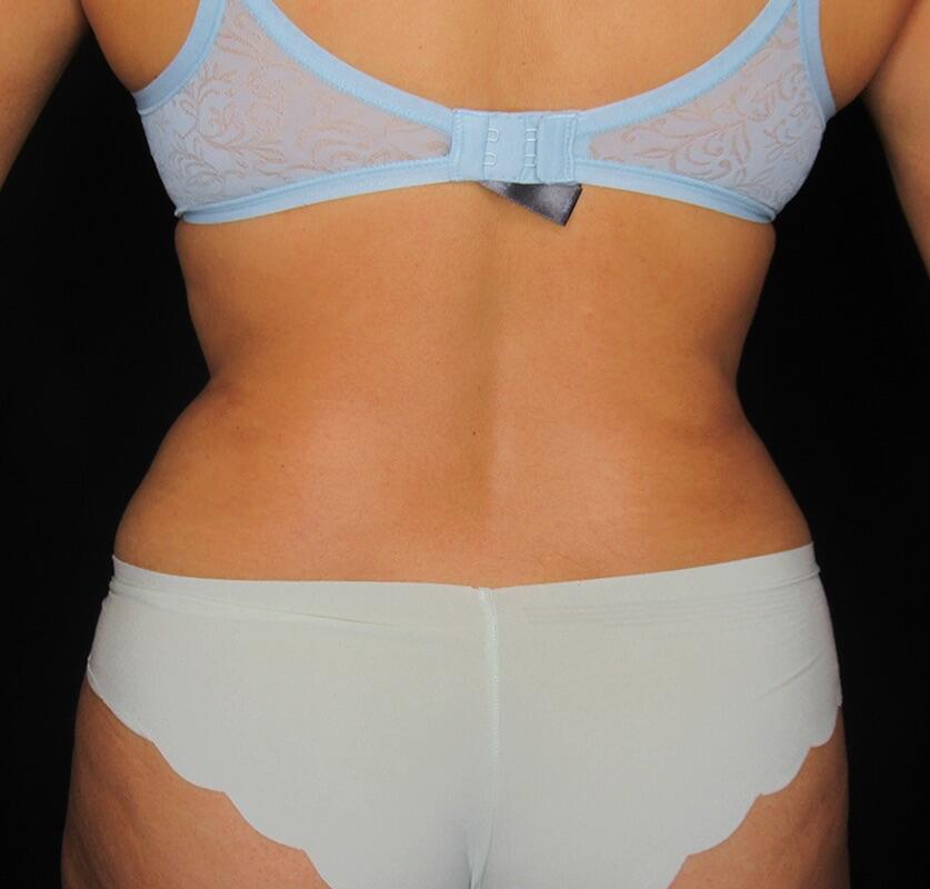 Liposuction Before & After Image