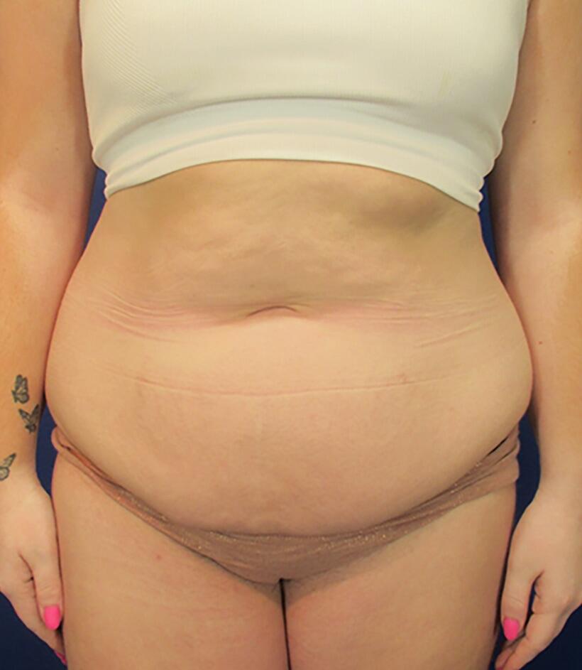 Mini Tummy Tuck Before & After Image