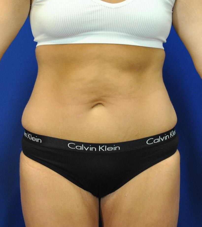 Mini Tummy Tuck Before & After Image