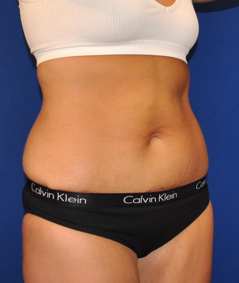 Mini Tummy Tuck Before & After Image