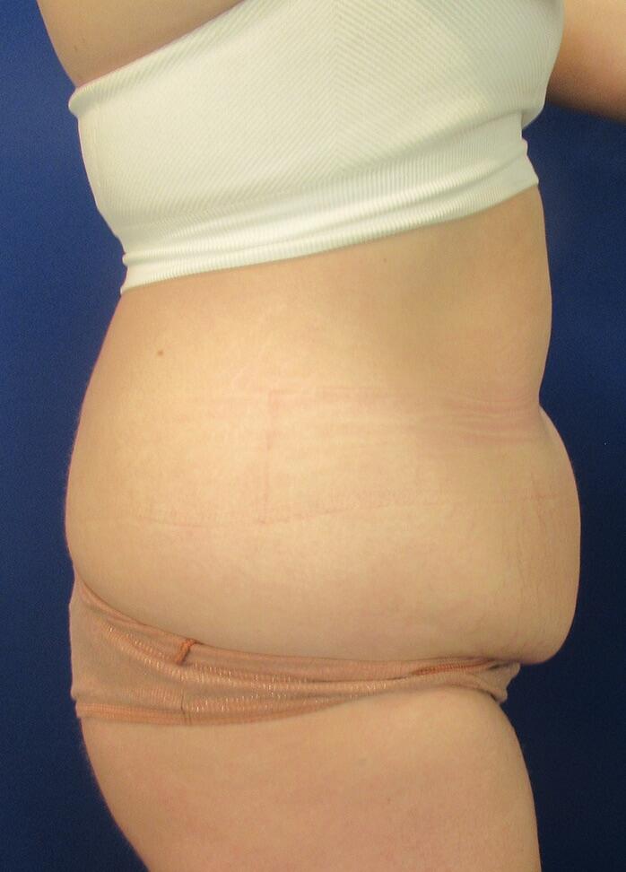 Mini Tummy Tuck Before & After Image