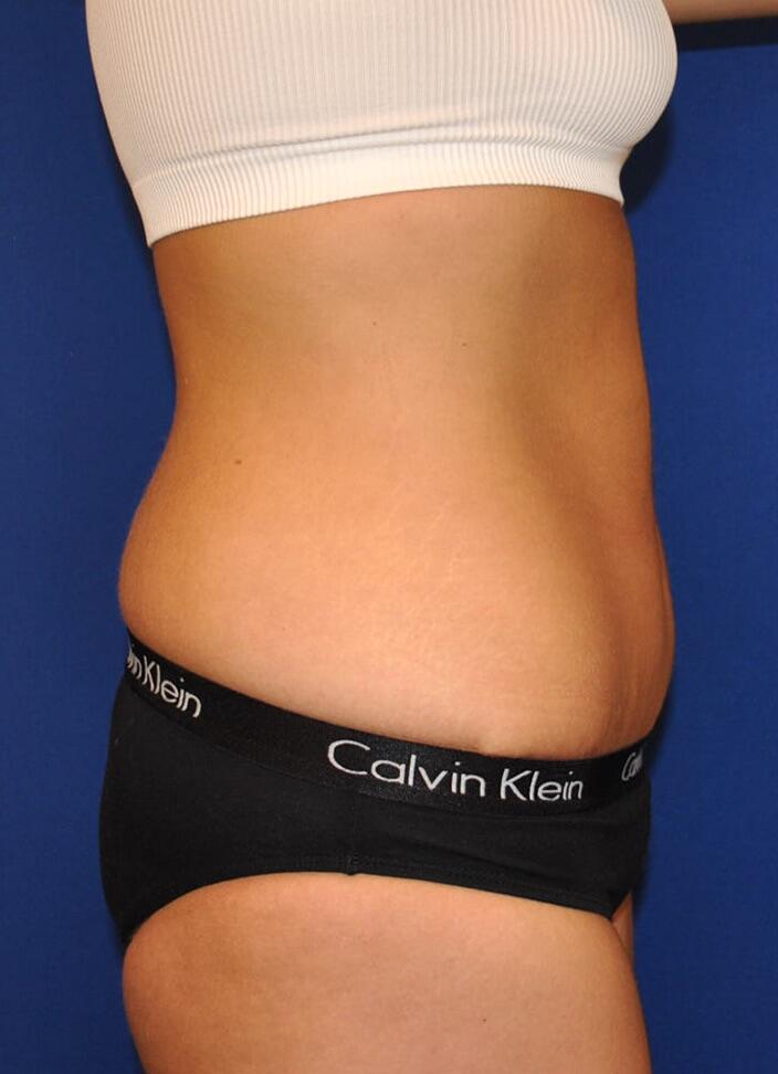 Mini Tummy Tuck Before & After Image