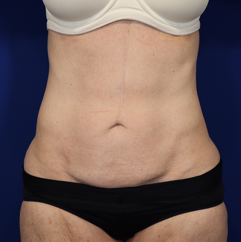 Mini Tummy Tuck Before & After Image