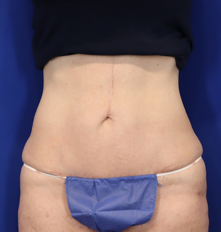 Mini Tummy Tuck Before & After Image