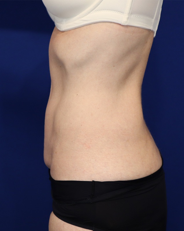 Mini Tummy Tuck Before & After Image