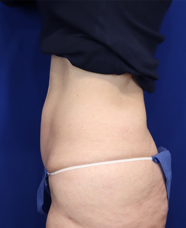 Mini Tummy Tuck Before & After Image