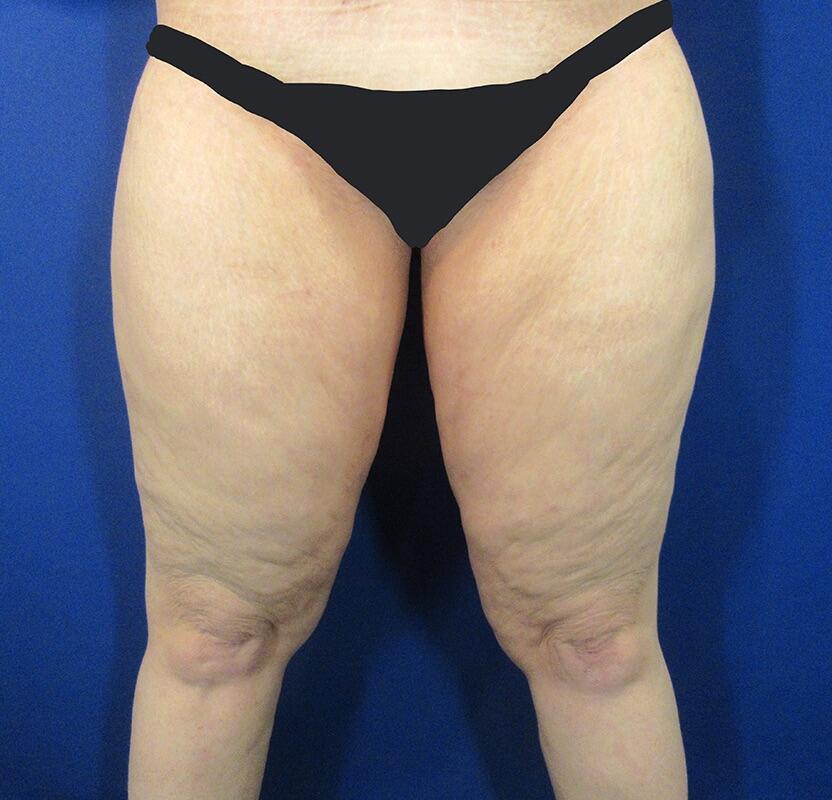 Thighplasty Before & After Image