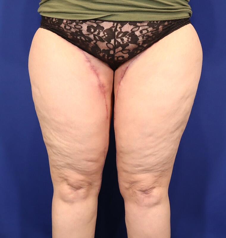 Thighplasty Before & After Image