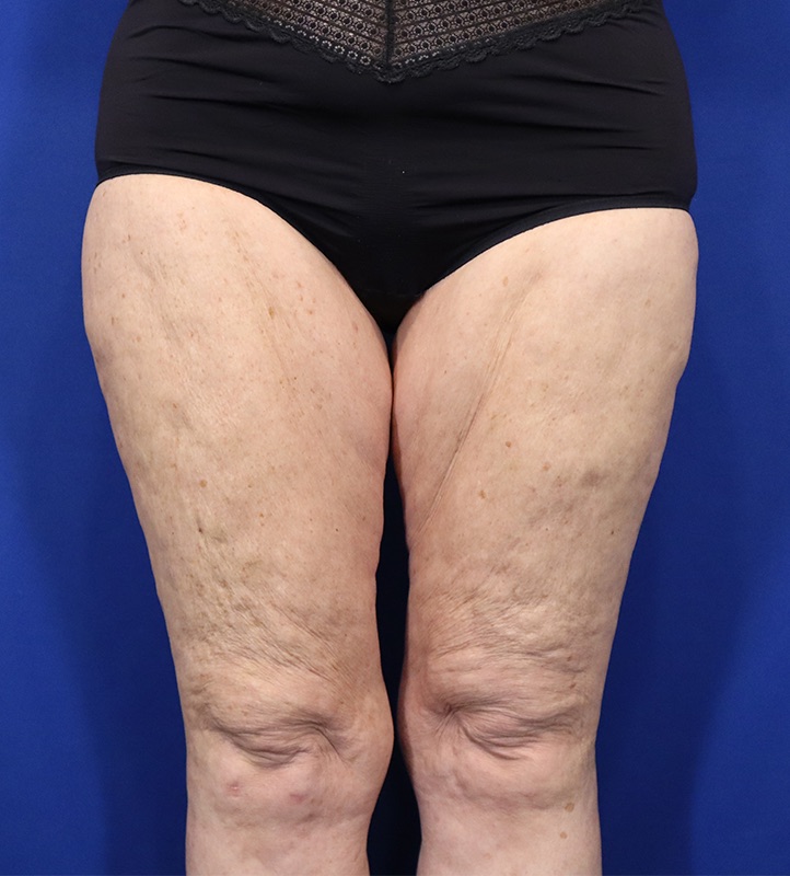 Thighplasty Before & After Image