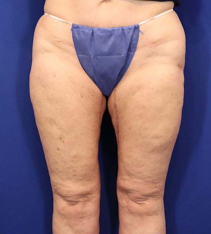 Thighplasty Before & After Image