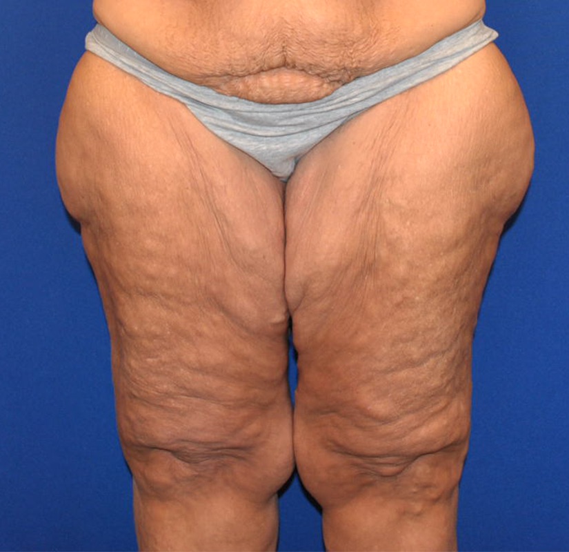 Thighplasty Before & After Image