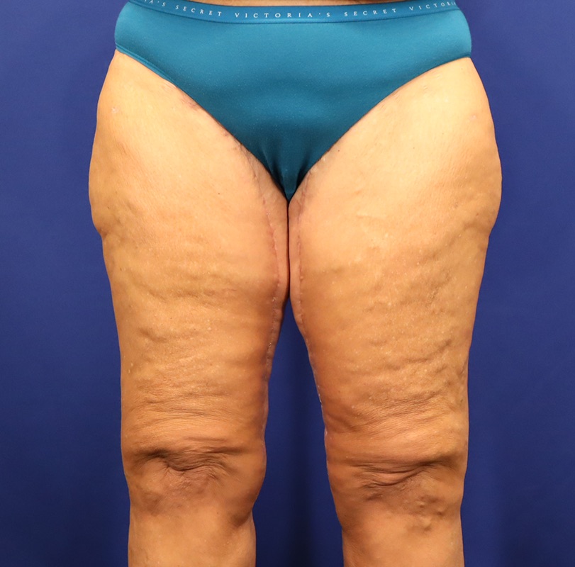 Thighplasty Before & After Image