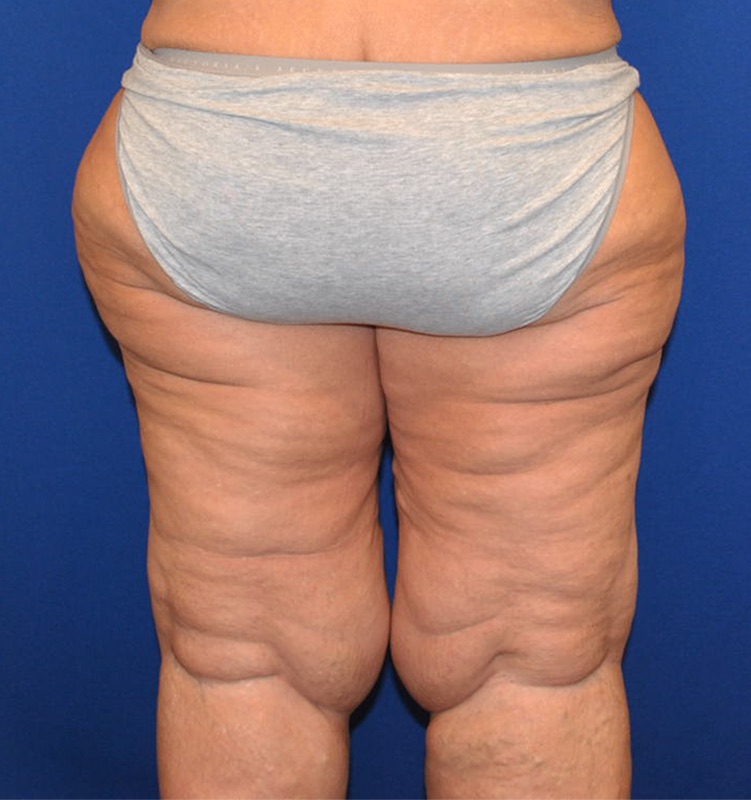 Thighplasty Before & After Image