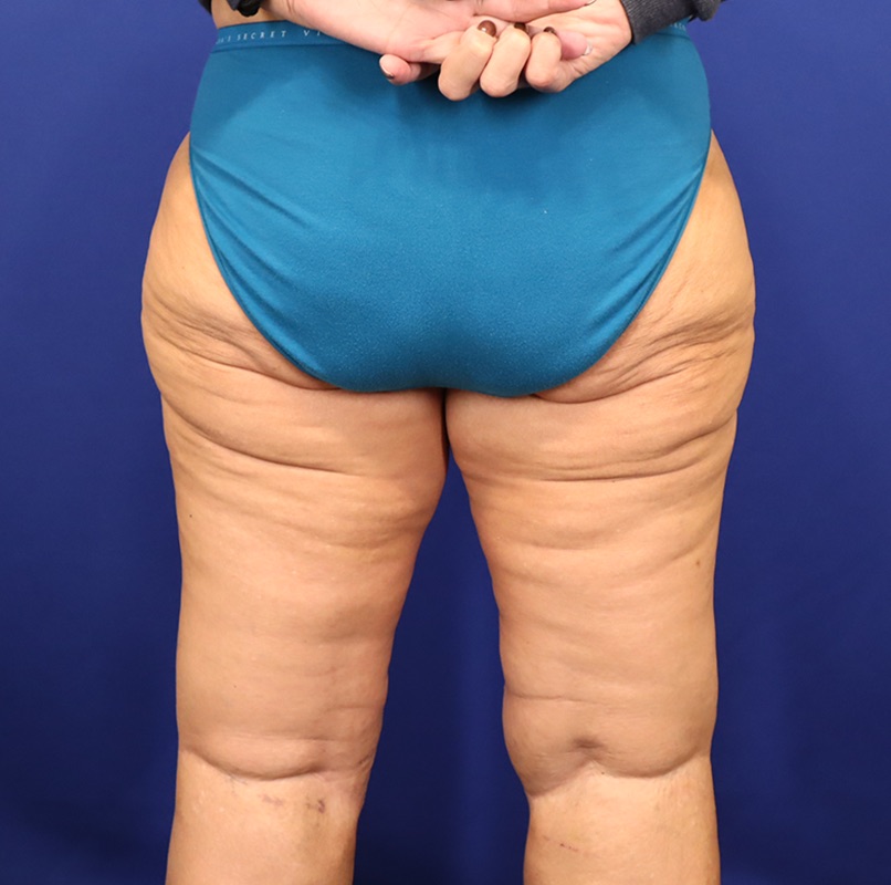 Thighplasty Before & After Image